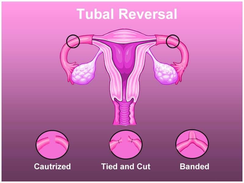 tubal ligation price Philippines